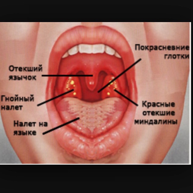 Гнойные прыщи при ангине Гнойные прыщи при ангине