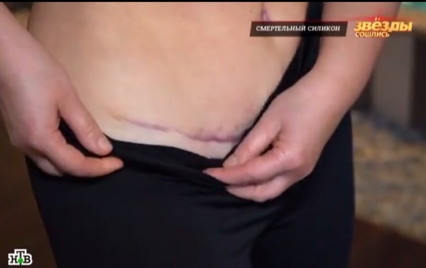 Новости дня: 51-летняя дочь Федосеевой-Шукшиной показала ужасный шрам на теле