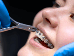 Лечение зубов на брекетах: ваше руководство к здоровой улыбке