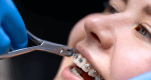 Лечение зубов на брекетах: ваше руководство к здоровой улыбке